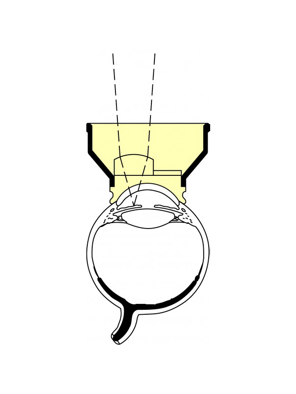 OAIA_1 Abraham Iridectomy Laser Lens