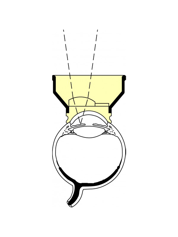 OAIY_1 Abraham Iridectomy Laser Lans YAG
