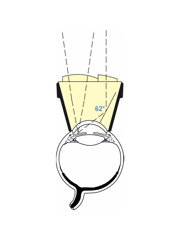 OPIG_1 Pollack Iridotomy - Gonio Laser Lens